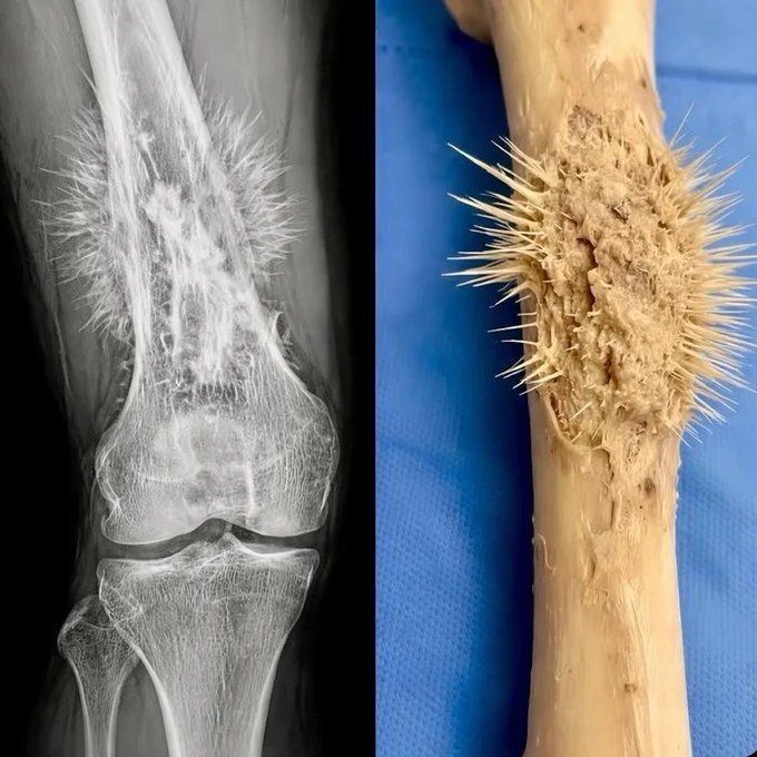 YosuepEstebanX's tweet photo. ¿Lidiando con el cáncer? 
El primer paso es eliminar por completo el consumo de azúcar; sin azúcar en el cuerpo, las células cancerosas morirían de muerte natural. 
 
Si tuviera cáncer, haría esto inmediatamente… https://t.co/wpTEVyTAZq