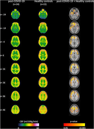 evelio_prieto's tweet photo. 🌀🧠🌀SENSIBILIZACIÓN CENTRAL EN LA COVID PERSISTENTE: DISAUTONOMÍA, HIPOPERFUSIÓN CEREBRAL Y NEUROINFLAMACIÓN
🧵1⃣🇺🇸Artículo de 2 neurólogos de Mass General Brigham, Facultad de Medicina de Harvard
https://t.co/umqE16SWFV https://t.co/riuwLqYpD9