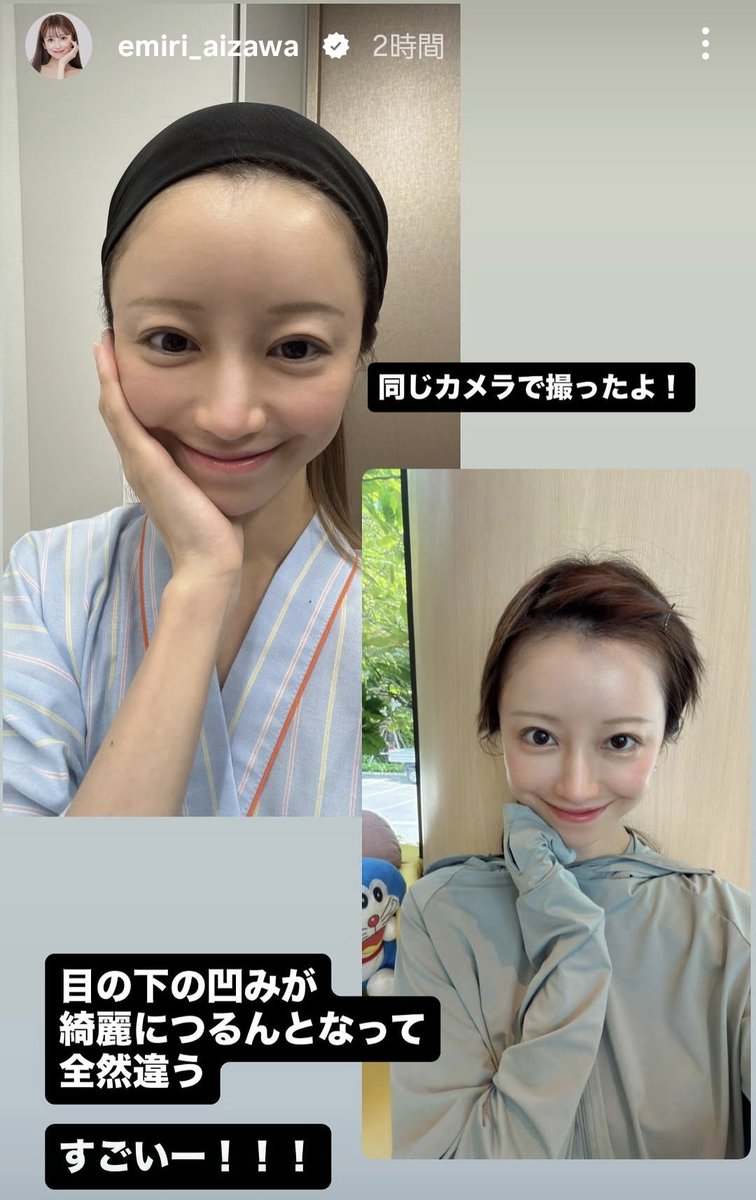 nyunnyun05's tweet photo. 愛沢えみりさんが手術内容&amp;執刀医公開してくれた👨‍⚕️
- Vclinic 銀座院 🇯🇵
- 院長 田中隆太郎先生
   日本形成外科学会専門医

クマ修正&amp;ミッドチークリフトでほっぺの脂肪を移動すごく自然でゴルゴ線もなくなってる✨希望の目元&amp;ほっぺがつるんと上がって仕上がり最高すぎんか
#整形垢さんと繋がりたい https://t.co/EdAqT51cOk