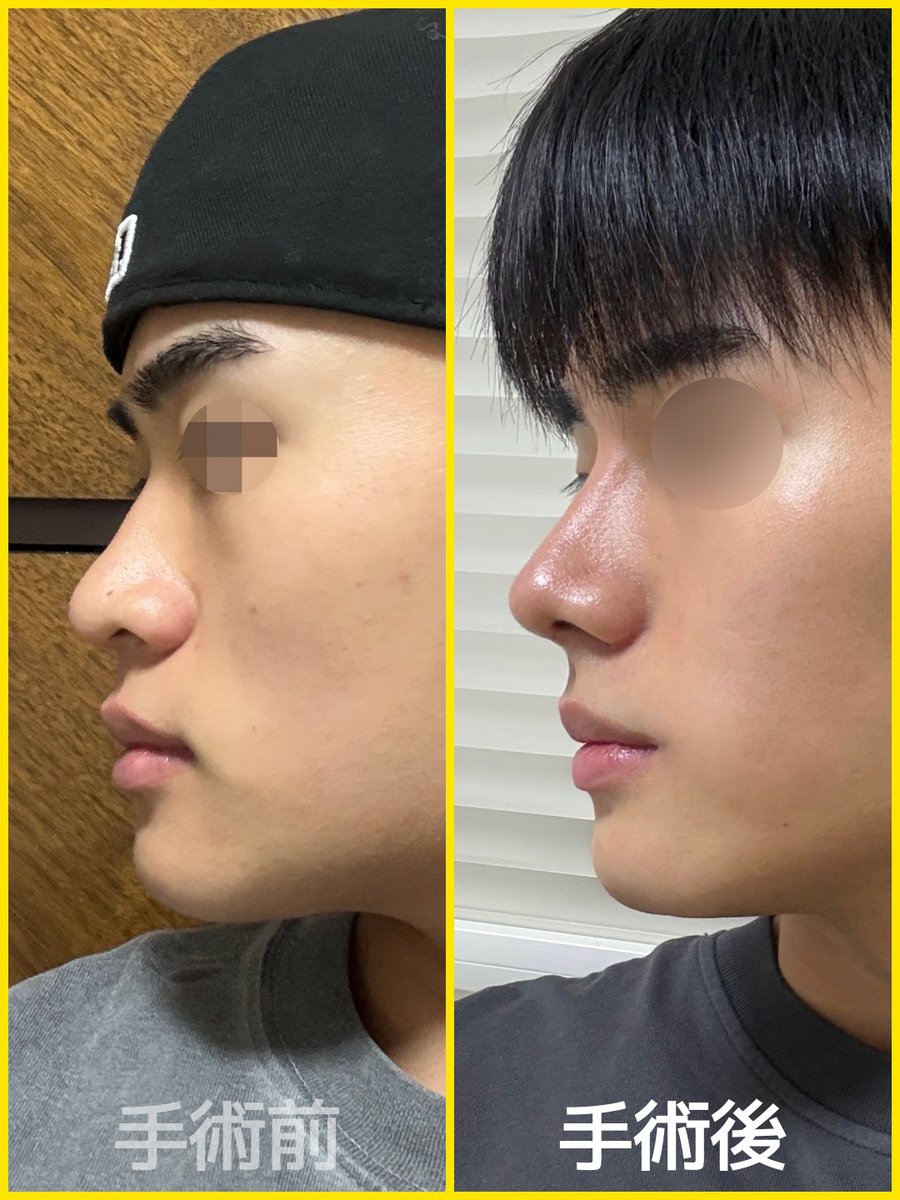 bananaps__'s tweet photo. バナナ美容整形外科 鼻手術 症例🍌

バナナ美容整形外科では男性の鼻手術も人気です💝

鼻手術に迷っている男性のお客様に参考にどうぞ✨

#鼻 #鼻整形 #鼻手術 #鼻フル #鼻修正 #鼻DT #鼻フルDT #鼻フルレポ #整形情報 #整形レポ #整形垢 #整形垢さんと繋がりたい #ダウンタイム https://t.co/wgMyWqKHws
