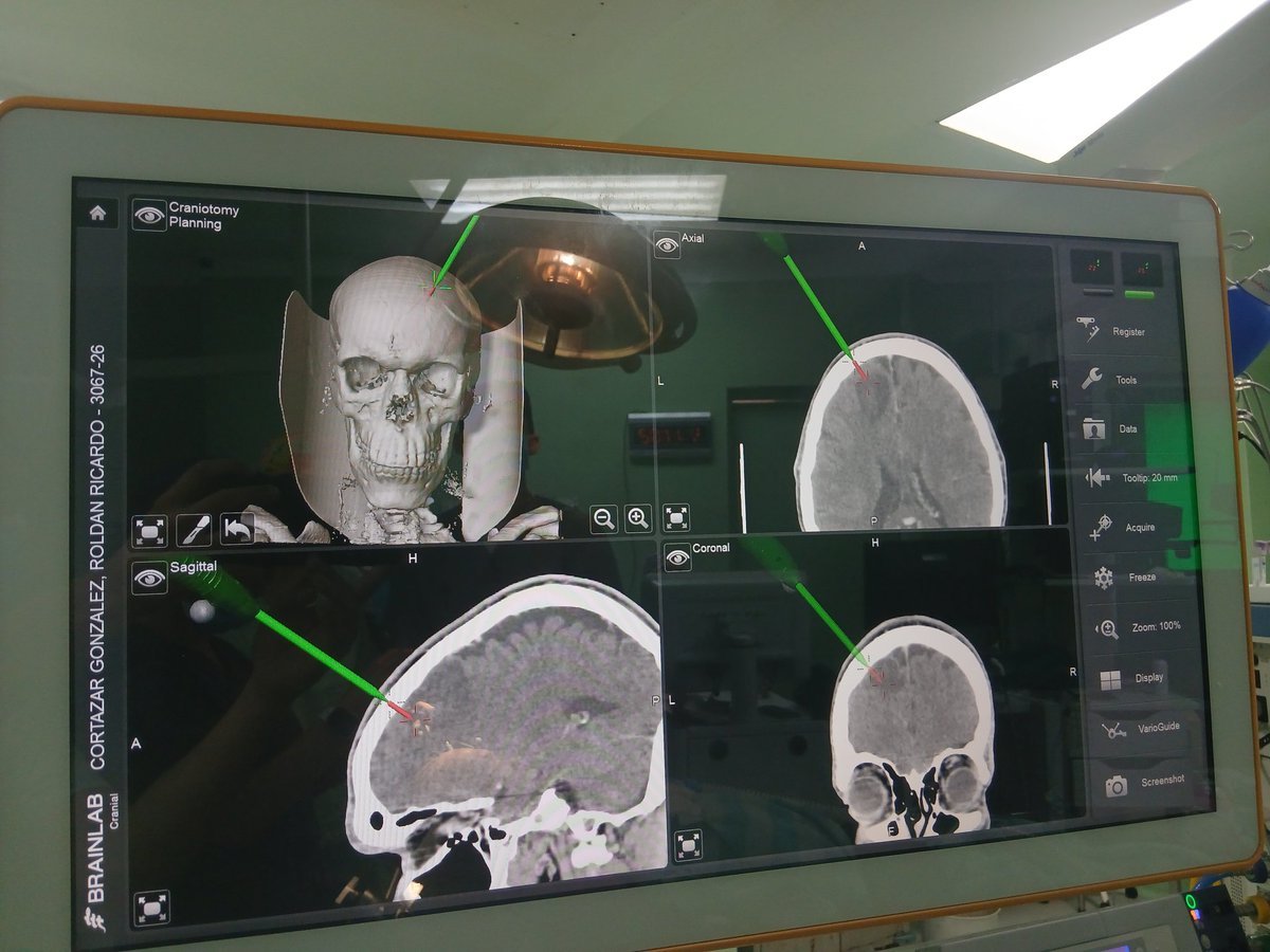 CarlosAUrbina3's tweet photo. Toma de biopsia guiada por Neuroavegador... #tumorcerebral #lesionesmultiples #gliomamultifocal #gliomadealtogrado #Neurocirugía #neuronavegador https://t.co/GYMIsqIjfl