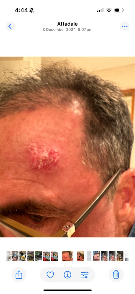 catchi888's tweet photo. @annvandersteel Just use black salve, got rid of a nasty infiltrative bcc in a few days and that last photo was a month later https://t.co/GPa575YrkE