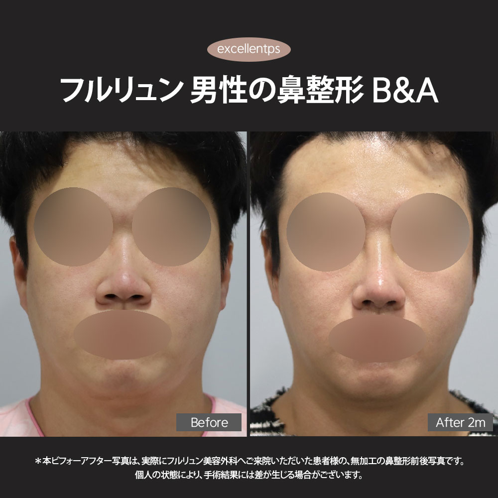 excellent_ps's tweet photo. 男性の鼻整形で大切なのは、
“高さ”よりも“顔全体とのバランス”。

フルリュン美容外科では3D-CTで鼻骨・軟骨・左右差まで細かく確認し、
形成外科専門医 キム・ヒョドン院長が
自然で男性らしい鼻ラインを丁寧にデザインします。

やりすぎないのに、印象は変わる。
自然なメンズ鼻整形ならフルリュン美容外科へ。

日本語相談はLINEから
📩LINE：@excellentps

#男性鼻整形 #メンズ鼻整形 #韓国鼻整形 #鼻整形 #渡韓整形 #自然な鼻整形 #3DCT鼻整形 #韓国美容外科 #フルリュン美容外科