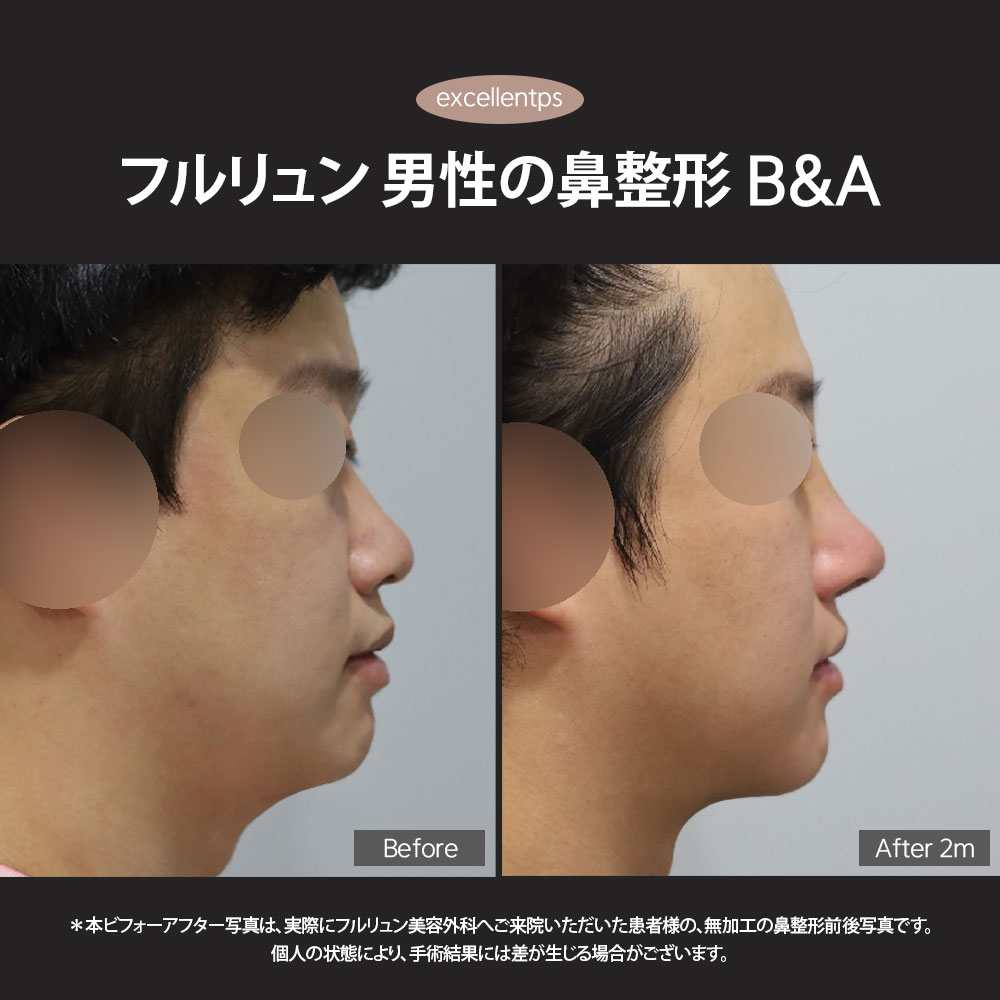excellent_ps's tweet photo. 男性の鼻整形で大切なのは、
“高さ”よりも“顔全体とのバランス”。

フルリュン美容外科では3D-CTで鼻骨・軟骨・左右差まで細かく確認し、
形成外科専門医 キム・ヒョドン院長が
自然で男性らしい鼻ラインを丁寧にデザインします。

やりすぎないのに、印象は変わる。
自然なメンズ鼻整形ならフルリュン美容外科へ。

日本語相談はLINEから
📩LINE：@excellentps

#男性鼻整形 #メンズ鼻整形 #韓国鼻整形 #鼻整形 #渡韓整形 #自然な鼻整形 #3DCT鼻整形 #韓国美容外科 #フルリュン美容外科