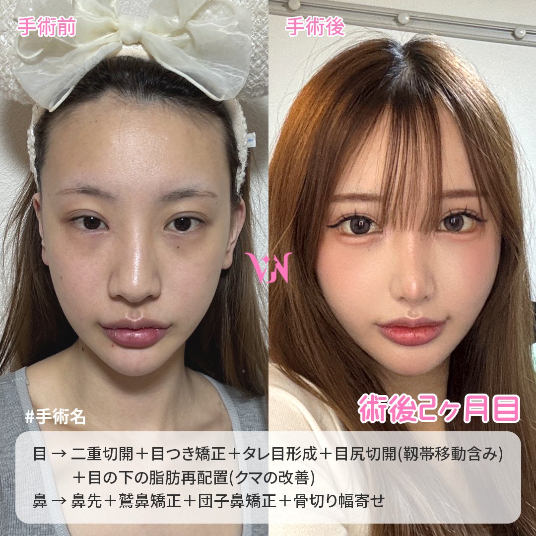 vannypsjp's tweet photo. 💖バンニ美容外科　症例写真💖

🔸手術内容🔸
【目】 二重切開＋目つき矯正＋タレ目形成(＝目下切開)＋目尻切開(靱帯移動含み)＋目の下の脂肪再配置(クマの改善)
【鼻】 鼻先＋鷲鼻矯正＋団子鼻矯正＋骨切り幅寄せ 

『開きにくい・多重ライン」だった目元がここまで変化👀✨
高すぎた二重幅を調整し、開眼力もアップ。
縦幅がしっかり出て、ぱっちり大きな目元に。
さらにクマ・くすみも脂肪再配置でしっかり改善。

鼻は鼻尖形成＋骨切りで、ぼやけた印象から一気にシャープなラインへ。
横顔までしっかり洗練された印象に✨』

お問い合わせや施術予約は公式LINEまで💌
https://t.co/4O2j3YLgFq 

ホームページ 
https://t.co/g33AhhBrw4

#韓国整形 #二重整形 #二重再手術 #自然癒着 #二重切開 #目つき矯正 #眼瞼下垂 #目上切開 #目頭切開 #目尻切開 #タレ目切開 #目下切開 #額挙上 #鼻整形 #鼻再手術 #鼻筋 #鼻先 #団子鼻矯正 #鷲鼻矯正 #低い鼻矯正 #長い鼻矯正 #短い鼻矯正 #鼻唇角矯正 #小鼻縮小 #機能鼻手術 #下鼻甲介 #鼻中隔湾曲症 #クリニック
