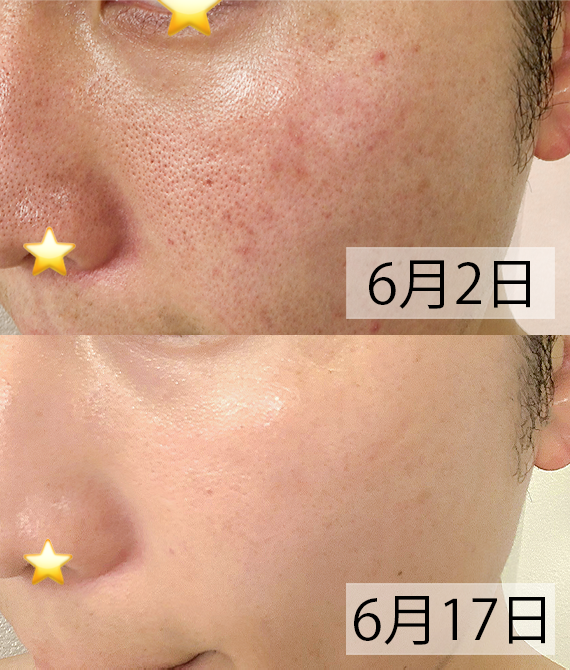 ann_melody2's tweet photo. インナードライで皮脂多めのメンズ肌でもここまで変わる。レチノールが肌再生してPDRNが肌の水分量増やして皮脂抑えるからマジで毛穴なくなる。 https://t.co/wGoPpkiNDu