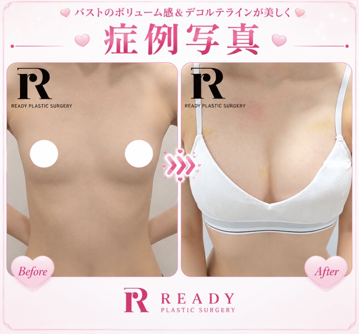 READYPS_JP's tweet photo. シリコンはちょっと怖い…

そんな方に人気なのが
脂肪豊胸🩷

自分の脂肪だから

✨自然
✨柔らかい
✨バレにくい

ナチュラル派さんに選ばれている
#脂肪豊胸 です💕 https://t.co/0fnFHnh9Rw