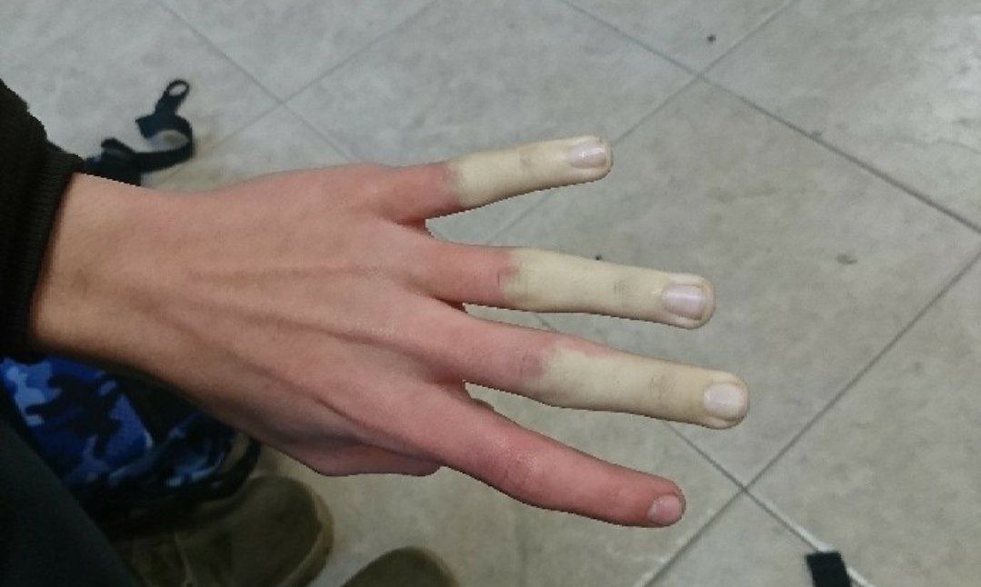 Benji4322's tweet photo. Reynauds in the dead of summer fingers cold as ice and painful af all day 

🗣️ “Remember when the ALPHA was floating around, before the fancy jabs came out, and people had “strange symptoms like hella loss of taste and smell &amp; reynauds?” 

whoopee gain of function https://t.co/QGGAWrgCeU