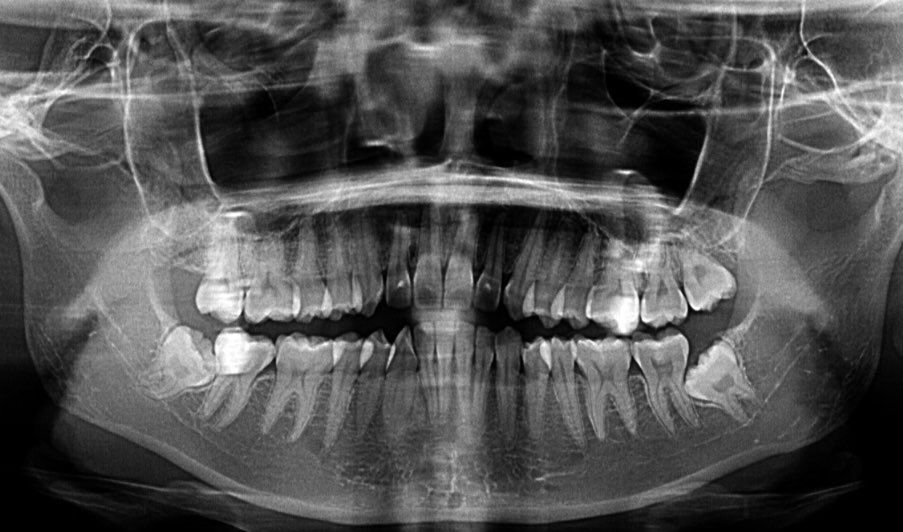 idahhd's tweet photo. hehehe, gajadi konseran
disuruh cabut wisdom teeth impaction dulu :) terimakasih semuanya 😭🥹 https://t.co/vgBEPHlrVu