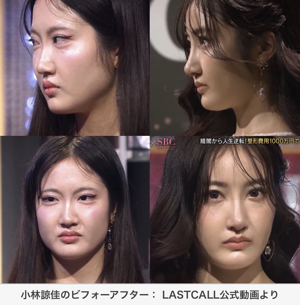 mtgjdpa's tweet photo. 【悲報】ラストコールの青学さん、二重全切開に目頭切開して、鼻尖形成3d法やってプロテーゼ入れて鼻整形してもメルカトル図法みたいな実際の輪郭3点サイズ一生変わらんの残酷すぎる。

視聴者がもてはやして混沌さんみたいなみんなのオモチャになっちゃったの可哀想。。。 https://t.co/4mpsbeWBrG
