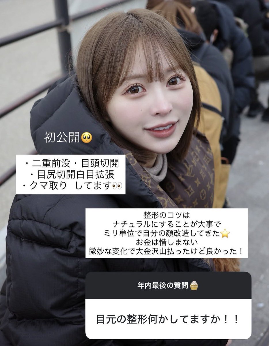 hmweum's tweet photo. ジャングル東京ななにーの整形レシピ出てきたけど、微調整でマイルドにやってくタイプなんだね！！
目👀
・二重埋没法・裏ハムラ（クマ取り）
・下眼瞼下制・目頭切開

輪郭👩🏻
・頬顎下脂肪吸引3回
・ジョールファット除去
・バッカルファット除去
・メーラーファット除去
・ナゾラビアル除去
・糸リフト2回

脂肪吸引取られすぎて失敗→ヒアルで修正

顔ヒアル
・顎ヒアル
・唇ヒアル
・肩ヒアル
・立ち耳ヒアル

鼻👃
・鼻先ヒアル
・貴族ヒアル
・鼻中隔ヒアル

・エラボトックス
・広頸筋ボトックス
・スキンボトックス
・口角ボトックス
・二の腕脂肪吸引
・太もも脂肪吸引