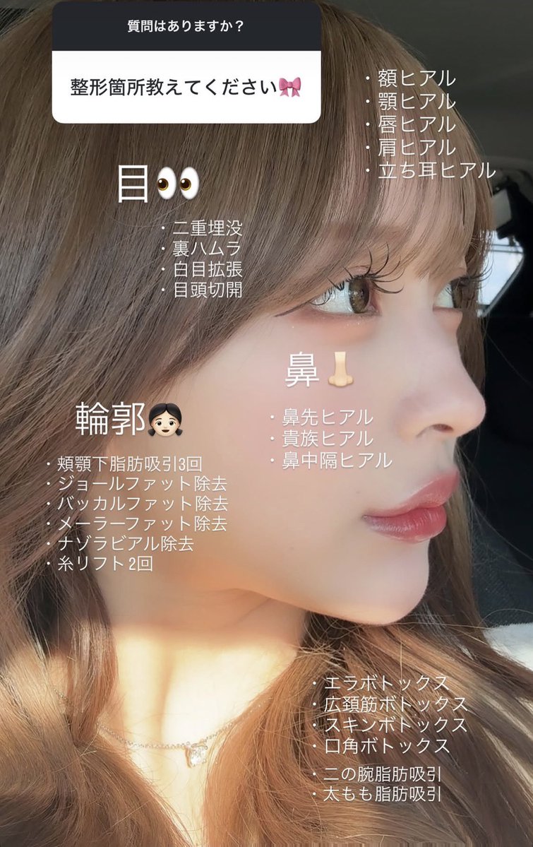 hmweum's tweet photo. ジャングル東京ななにーの整形レシピ出てきたけど、微調整でマイルドにやってくタイプなんだね！！
目👀
・二重埋没法・裏ハムラ（クマ取り）
・下眼瞼下制・目頭切開

輪郭👩🏻
・頬顎下脂肪吸引3回
・ジョールファット除去
・バッカルファット除去
・メーラーファット除去
・ナゾラビアル除去
・糸リフト2回

脂肪吸引取られすぎて失敗→ヒアルで修正

顔ヒアル
・顎ヒアル
・唇ヒアル
・肩ヒアル
・立ち耳ヒアル

鼻👃
・鼻先ヒアル
・貴族ヒアル
・鼻中隔ヒアル

・エラボトックス
・広頸筋ボトックス
・スキンボトックス
・口角ボトックス
・二の腕脂肪吸引
・太もも脂肪吸引
