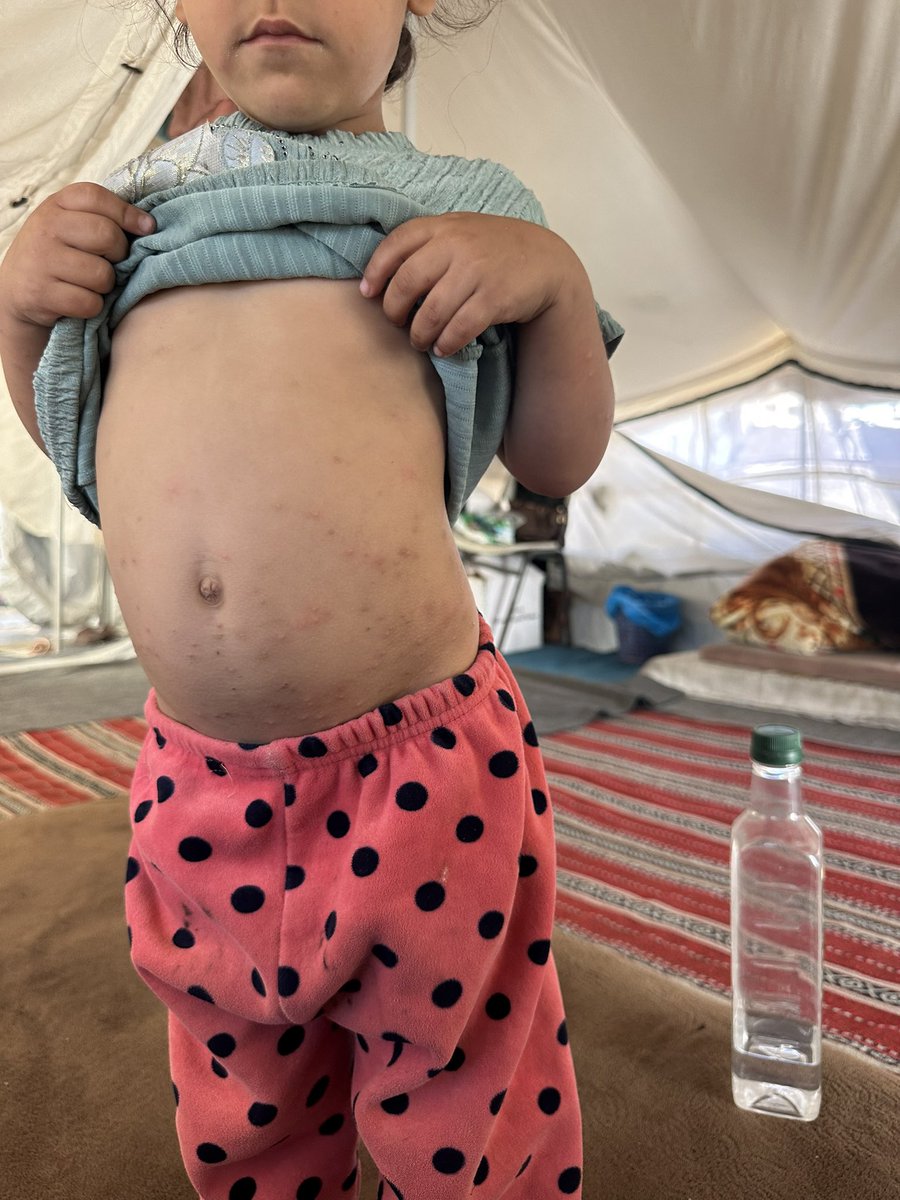Tameralmasri90's tweet photo. Zain is home from the hospital today by the grace of God and your noble hearts! 🙏❤️ But "home" means returning to a cramped, suffocating tent that is fully infested with fleas, rats, and weasels. 
The nightmare isn't over. We haven't even raised half of our campaign goal. Zain needs expensive specialized food and treatment for his lung infection, severe stomach issues, and acute anemia. On top of that, my children are scratching their skin until they bleed due to the insect bites, requiring constant medical creams. 
I have 7 children to protect. Three are under 5, including my 4-month-old baby Layan who lacks milk and diapers. I am completely exhausted and lack the basic nutrition needed to stay strong for them. 
I apologize a million times for begging, but my pride is nothing compared to my children's lives. Please don't let a desperate mother's heart break. Help us complete Zain's treatment and secure our survival. 
Every donation counts. Please support us through the link below: ⬇️😭🏥🎪
https://t.co/Orc3jzkMiM 

@NatalieGABand @bill2earth @NasserIbnHamad @jccfergie @RioSlade @LuDoRight @AlbLunaa @lunalunabraga @don_vulpine @ERubio11091 @motherhongjoong @ssuzie__ @realJessicaW @BlackBerner2020 @Bruller19 @PauletteAlt @AliSubul15119 @stephenfaigen @TaiyangPK @flrainh @HorrorGorl @MelkiJRussell @mirsalah @AngryHamhock @KlonnyPin_Gosch @pampa_gonzalez @7gmatematik7g @Calas_Gaby @BlaqAsssFilm @ShinyFluffdnd @mearajbhagad @mirsalah @RadioWatermelon @DonnaPlageman @ChrisFo98725734 @Cristiano @lvn_crypto @cryptobrough
