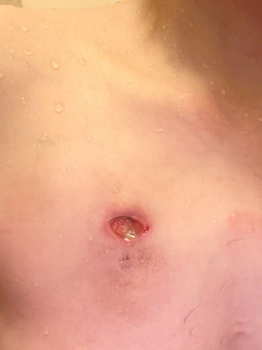 REMASAKI's tweet photo. この穴の中を
シャワー自己洗浄するんだよ😭😭😭

怖いよ😱😱😱
痛いよ😣😣😣
慣れるわけねーだろ！！

 #手術
 #CVポート
 #ITP
 #SLE https://t.co/sxxzrtBoXC