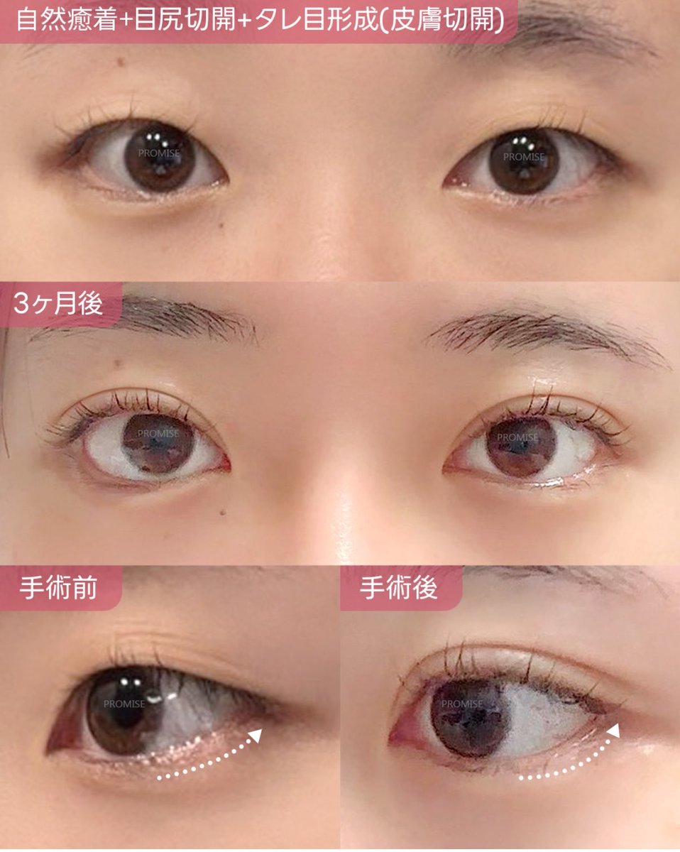 ebitenmania's tweet photo. さすがプロミ酢~目の専門医なだけあってナチュラルに目デカくするのうまい、私は全切開も目頭もここ、目尻はやる必要ないって言われてやらなかったけどこれ見るとまじでやりたくなる https://t.co/EH8uLfoujs