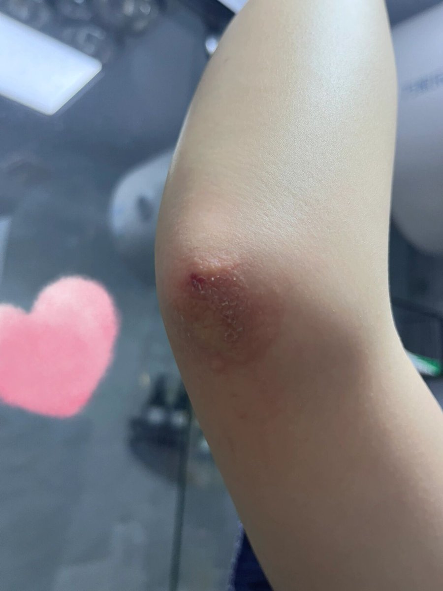 kume1211's tweet photo. 誰可以告訴我 
我昨天明明是跪著口 
手肘是怎麼受傷的呀….

#台灣 #臺灣 https://t.co/Nstb1EUmXa