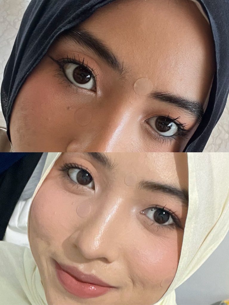 urcapripoean's tweet photo. Tiap ada acara penting entah kenapa selalu muncul jerawat yang posisi nya aneh" banget, biasanya aku tutupin pakai acne patch kaya gini. Kalian risih apa engga kalau ngeliat ada yg make kayak gini? https://t.co/rU6RwndKvH
