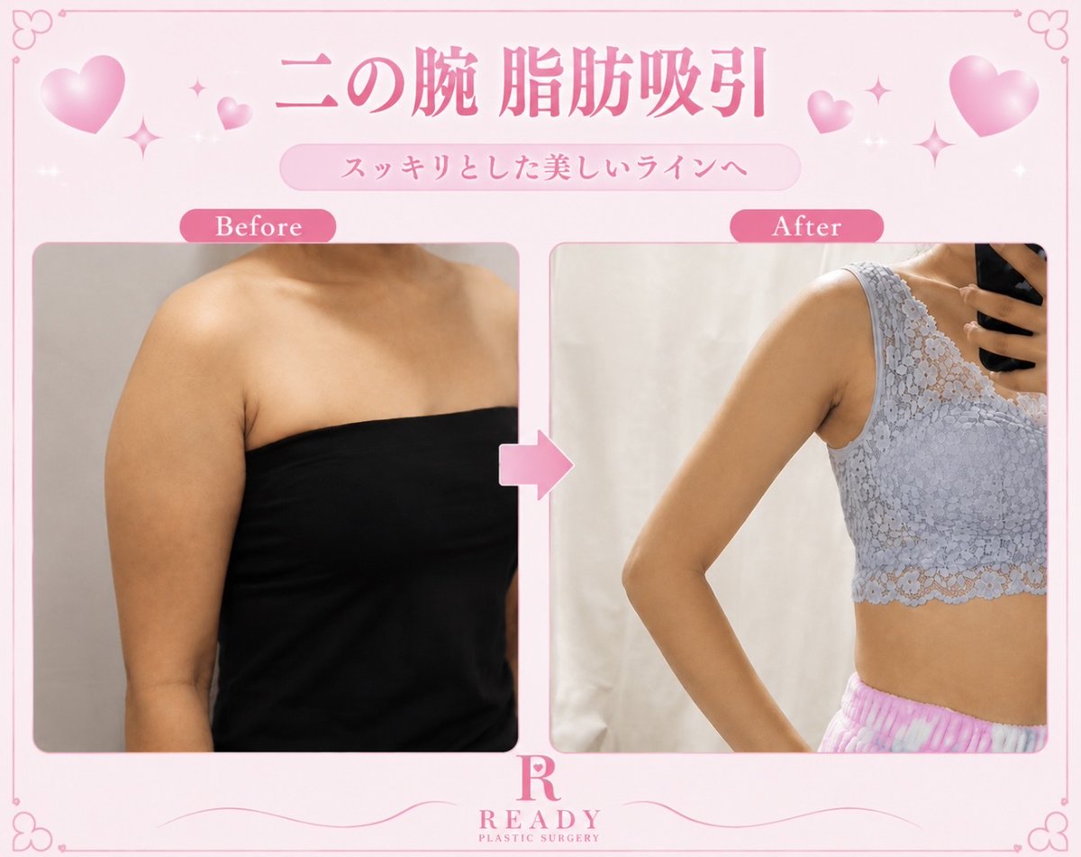 READYPS_JP's tweet photo. 「頑張っても二の腕だけ痩せない🥺」

そんなお悩みには二の腕脂肪吸引✨

READYでは取り残しを最小限に抑え、
華奢でカリカリなラインを目指します🩷

ノースリーブも怖くない💕
横から見ても後ろから見てもスッキリした二の腕へ🎀

#二の腕脂肪吸引 #二の腕 https://t.co/g4o5ve8WmL