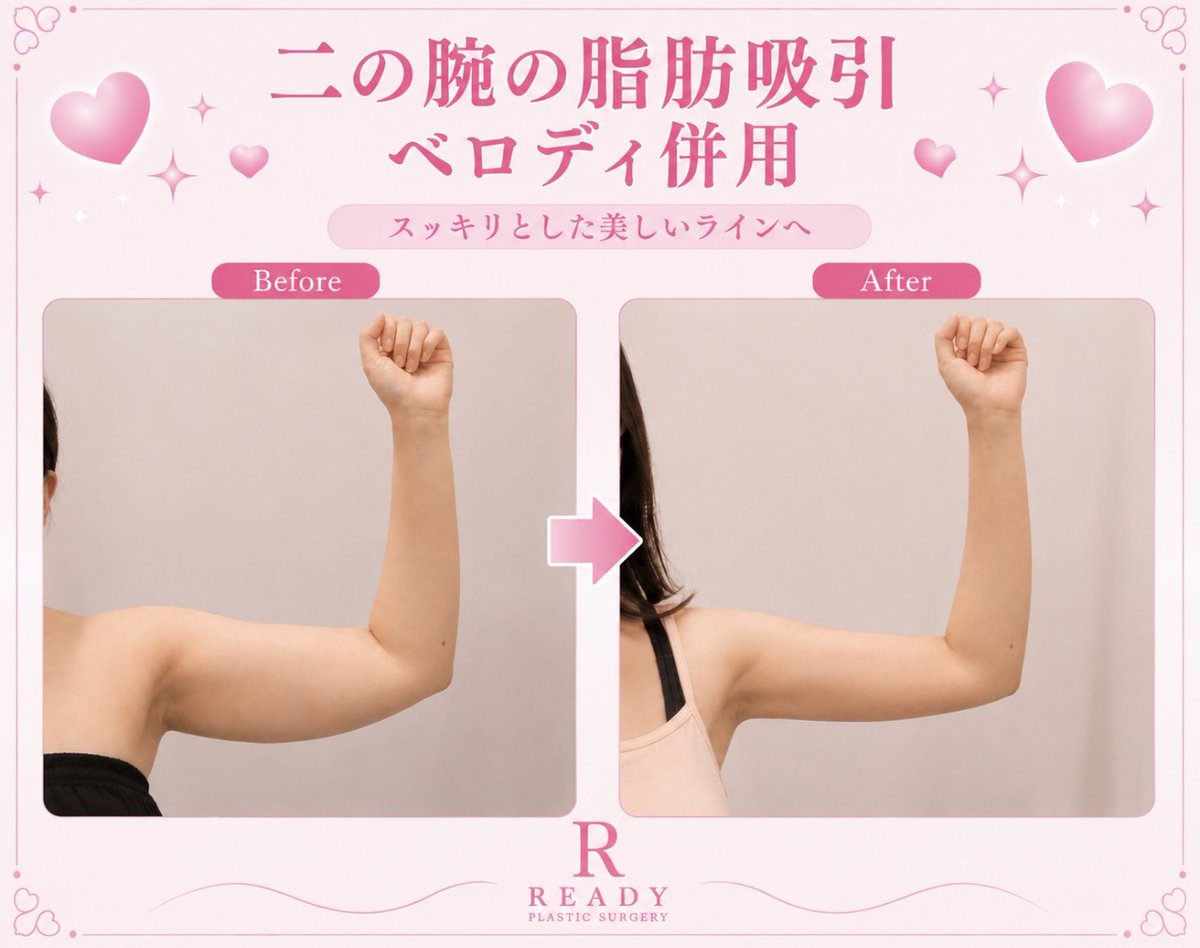 READYPS_JP's tweet photo. 脂肪吸引をしたらたるみが出てきた？

べロディ併用でたるみ対策をしつつ
より綺麗な仕上がりを目指せます𓂃🎀𓈒𓏸

脂肪を取るだけじゃなく、
カリカリで華奢な二の腕へ🩷

READYでは一人ひとりの皮膚の状態を確認しながら最適な施術をご提案いたします🎀✨

#二の腕脂肪吸引 https://t.co/bfhNO5b2dz