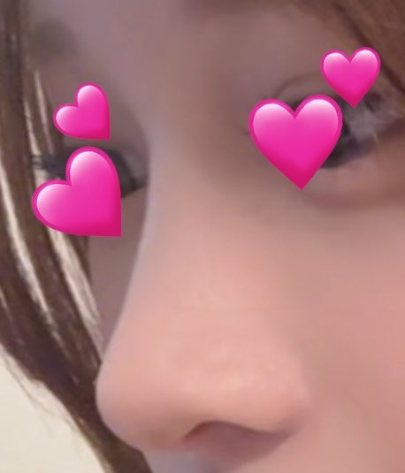 nung2j's tweet photo. 鼻フル DT 1ヶ月~𖤐 ̖́-
時の流れ早すぎる。鼻の高さも落ち着いてきました☺️🫶🏻正面からと横から https://t.co/HkEQ0eLFW9