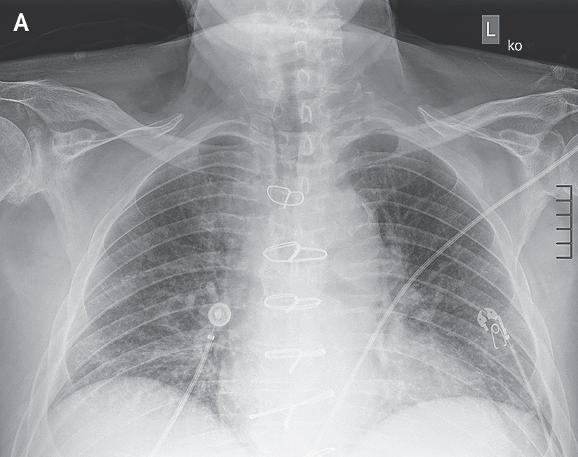 NEJM's tweet photo. Case Record of the Massachusetts General Hospital (@MassGeneralNews): A 74-year-old man was admitted to this hospital because of persistent pancytopenia that had resulted in multiple red-cell transfusions. 

Three months before the current presentation, the patient underwent heart transplantation after a prolonged admission in the cardiac intensive care unit of this hospital. He had been admitted for decompensated heart failure due to transthyretin amyloid cardiomyopathy, for which he received treatment with infusions of inotropic and diuretic agents. The preoperative course was notable for anemia, for which he received intravenous iron therapy. In addition, the patient had persistent thrombocytopenia that prompted a switch in treatment from heparin to a direct thrombin inhibitor, despite the fact that testing for antibodies against platelet factor 4 was negative. Serologic testing performed before transplantation was positive for Epstein–Barr virus (EBV) IgG, negative for cytomegalovirus (CMV) IgG, and negative for toxoplasma IgG. Serologic testing in the donor was positive for EBV IgG and CMV IgG and negative for toxoplasma IgG. 

Read the full case details in “A 74-Year-Old Man with Pancytopenia,” a Case Record of the Massachusetts General Hospital, by W.C. Aird et al.: https://t.co/NSqIDDQT0B 

Wondering how you might use this article in practice or teaching? AI Companion can help. Try it with this article.