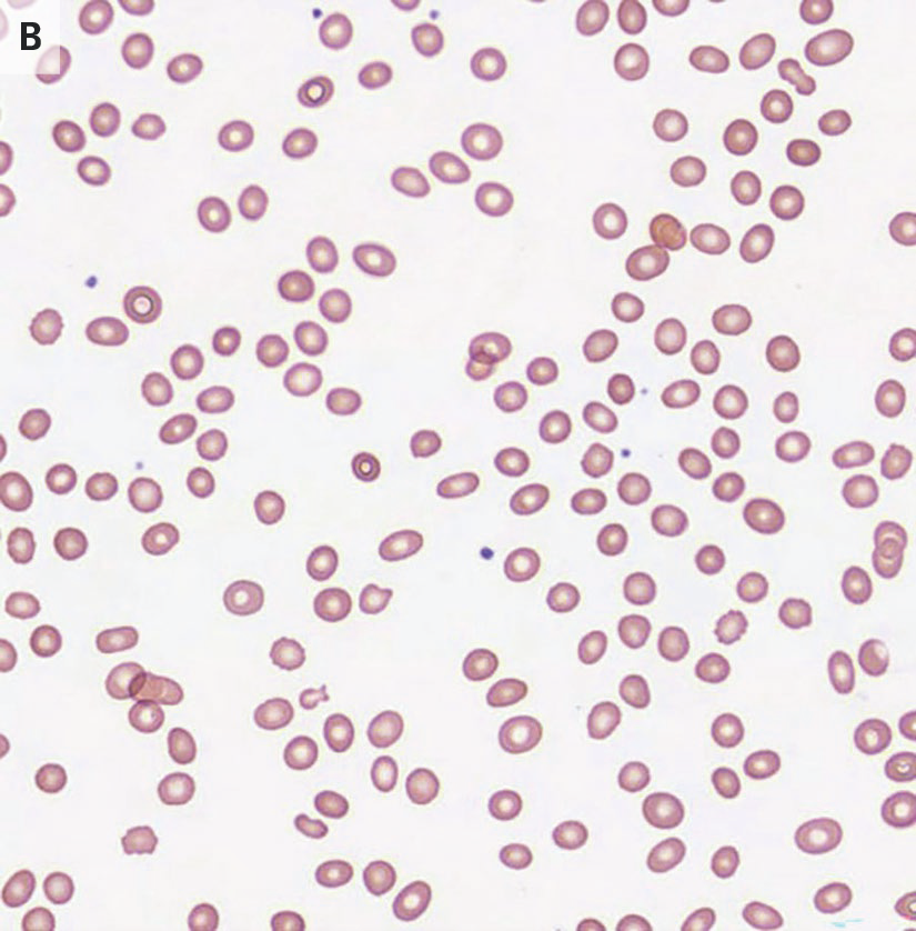 NEJM's tweet photo. Case Record of the Massachusetts General Hospital (@MassGeneralNews): A 74-year-old man was admitted to this hospital because of persistent pancytopenia that had resulted in multiple red-cell transfusions. 

Three months before the current presentation, the patient underwent heart transplantation after a prolonged admission in the cardiac intensive care unit of this hospital. He had been admitted for decompensated heart failure due to transthyretin amyloid cardiomyopathy, for which he received treatment with infusions of inotropic and diuretic agents. The preoperative course was notable for anemia, for which he received intravenous iron therapy. In addition, the patient had persistent thrombocytopenia that prompted a switch in treatment from heparin to a direct thrombin inhibitor, despite the fact that testing for antibodies against platelet factor 4 was negative. Serologic testing performed before transplantation was positive for Epstein–Barr virus (EBV) IgG, negative for cytomegalovirus (CMV) IgG, and negative for toxoplasma IgG. Serologic testing in the donor was positive for EBV IgG and CMV IgG and negative for toxoplasma IgG. 

Read the full case details in “A 74-Year-Old Man with Pancytopenia,” a Case Record of the Massachusetts General Hospital, by W.C. Aird et al.: https://t.co/NSqIDDQT0B 

Wondering how you might use this article in practice or teaching? AI Companion can help. Try it with this article.