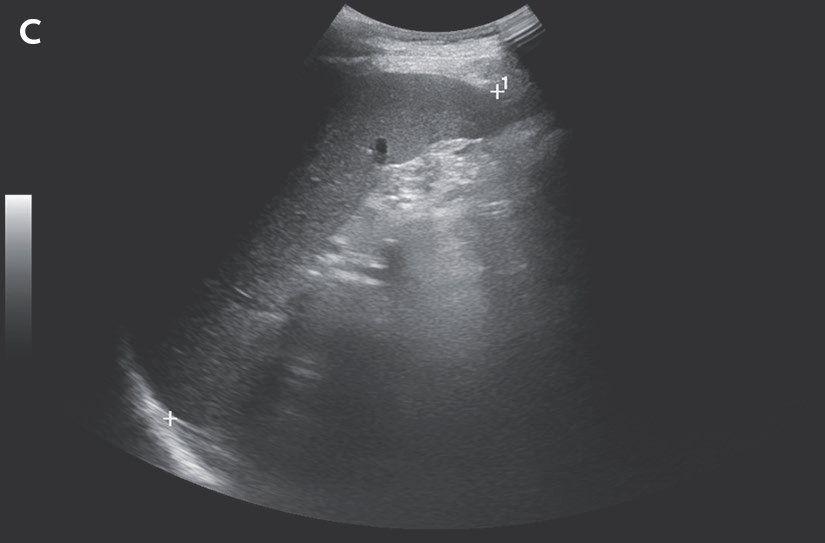 NEJM's tweet photo. Case Record of the Massachusetts General Hospital (@MassGeneralNews): A 74-year-old man was admitted to this hospital because of persistent pancytopenia that had resulted in multiple red-cell transfusions. 

Three months before the current presentation, the patient underwent heart transplantation after a prolonged admission in the cardiac intensive care unit of this hospital. He had been admitted for decompensated heart failure due to transthyretin amyloid cardiomyopathy, for which he received treatment with infusions of inotropic and diuretic agents. The preoperative course was notable for anemia, for which he received intravenous iron therapy. In addition, the patient had persistent thrombocytopenia that prompted a switch in treatment from heparin to a direct thrombin inhibitor, despite the fact that testing for antibodies against platelet factor 4 was negative. Serologic testing performed before transplantation was positive for Epstein–Barr virus (EBV) IgG, negative for cytomegalovirus (CMV) IgG, and negative for toxoplasma IgG. Serologic testing in the donor was positive for EBV IgG and CMV IgG and negative for toxoplasma IgG. 

Read the full case details in “A 74-Year-Old Man with Pancytopenia,” a Case Record of the Massachusetts General Hospital, by W.C. Aird et al.: https://t.co/NSqIDDQT0B 

Wondering how you might use this article in practice or teaching? AI Companion can help. Try it with this article.
