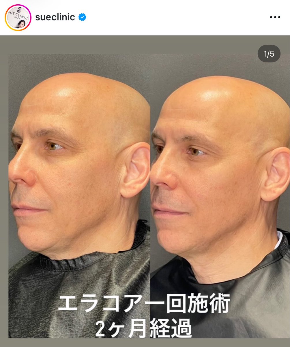 Yasagure_tokyo's tweet photo. こんなん物理的に効くに決まってるじゃん。エラコアやりたいけど症例がまだなさすぎる😂色素沈着こええぇ https://t.co/U1GZcmbOyQ