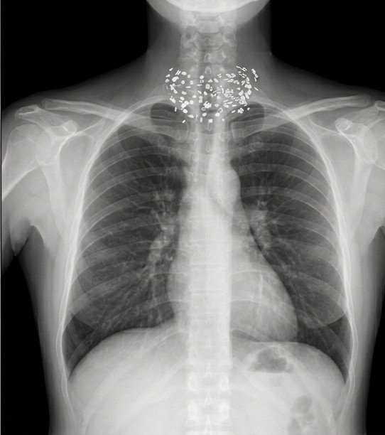 ardhiasaY's tweet photo. CKHI: CERITA KASUS HARI INI

Tau nggak kalau gaya rambut bisa bikin petugas radiologi garuk-garuk kepala? Ini bukan tentang model rambutnya, tapi tentang apa yang tersembunyi di dalamnya. Di dunia radiologi, benda sekecil klem hair extension bisa menciptakan "badai" artefak di hasil foto rontgen.

Coba perhatikan gambar rontgen thorax (dada) ini. Di area leher dan dada bagian atas, terlihat puluhan benda putih kecil, padat, dan berderet. Kalau tidak jeli, ini bisa disalahartikan sebagai pecahan logam, peluru tabur, susuk atau bahkan benda asing yang tertanam di dalam tubuh. Mengerikan, kan?

UTAS