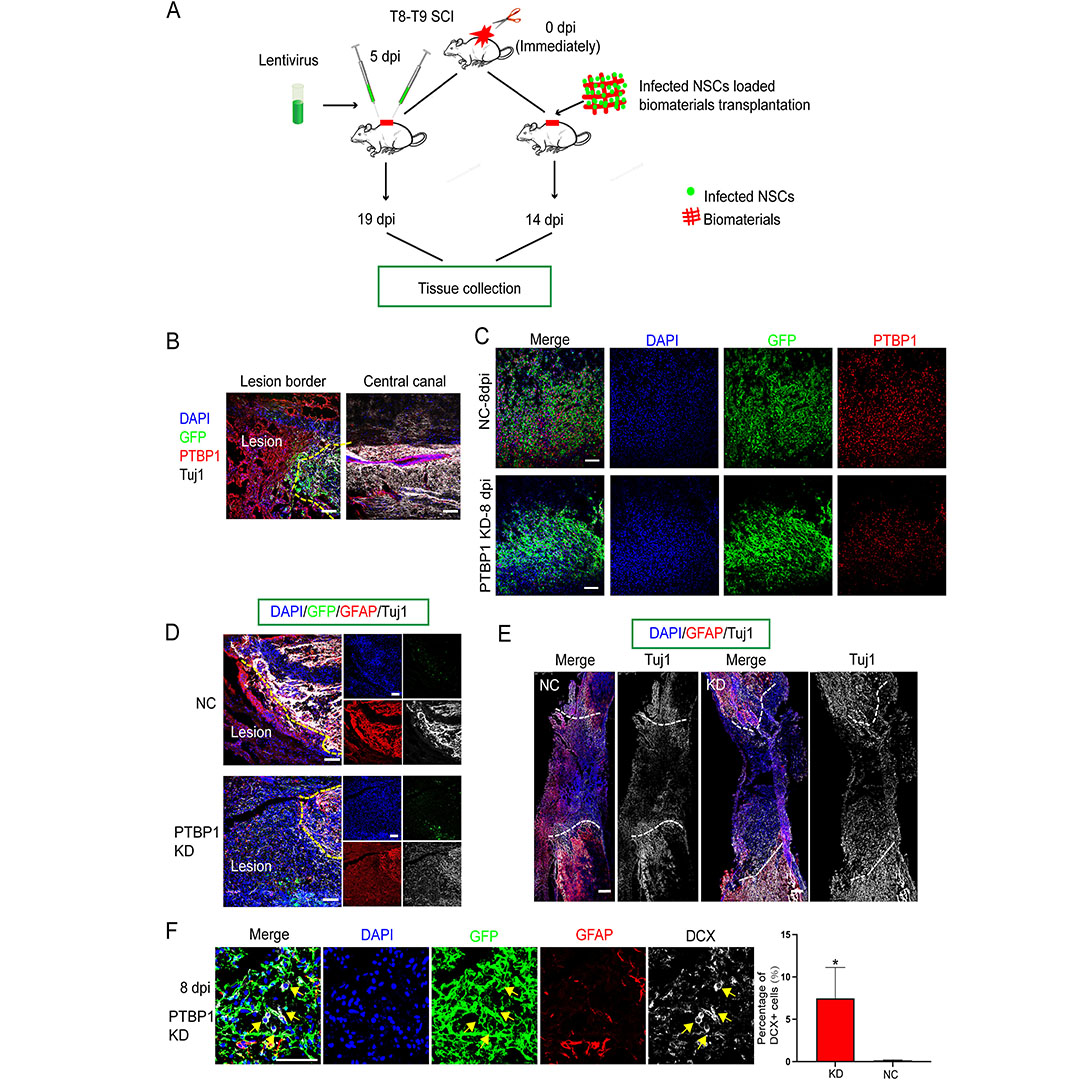 GenesNDiseases's tweet photo. Scientists show #PTBP1 suppression enhances neuronal differentiation of endogenous #NeuralStemCells after #SpinalCordInjury, promoting #neurogenesis and improving functional recovery, highlighting a promising regenerative approach.
#OpenAccess: https://t.co/lKryh1LQtJ https://t.co/50594aPjAX