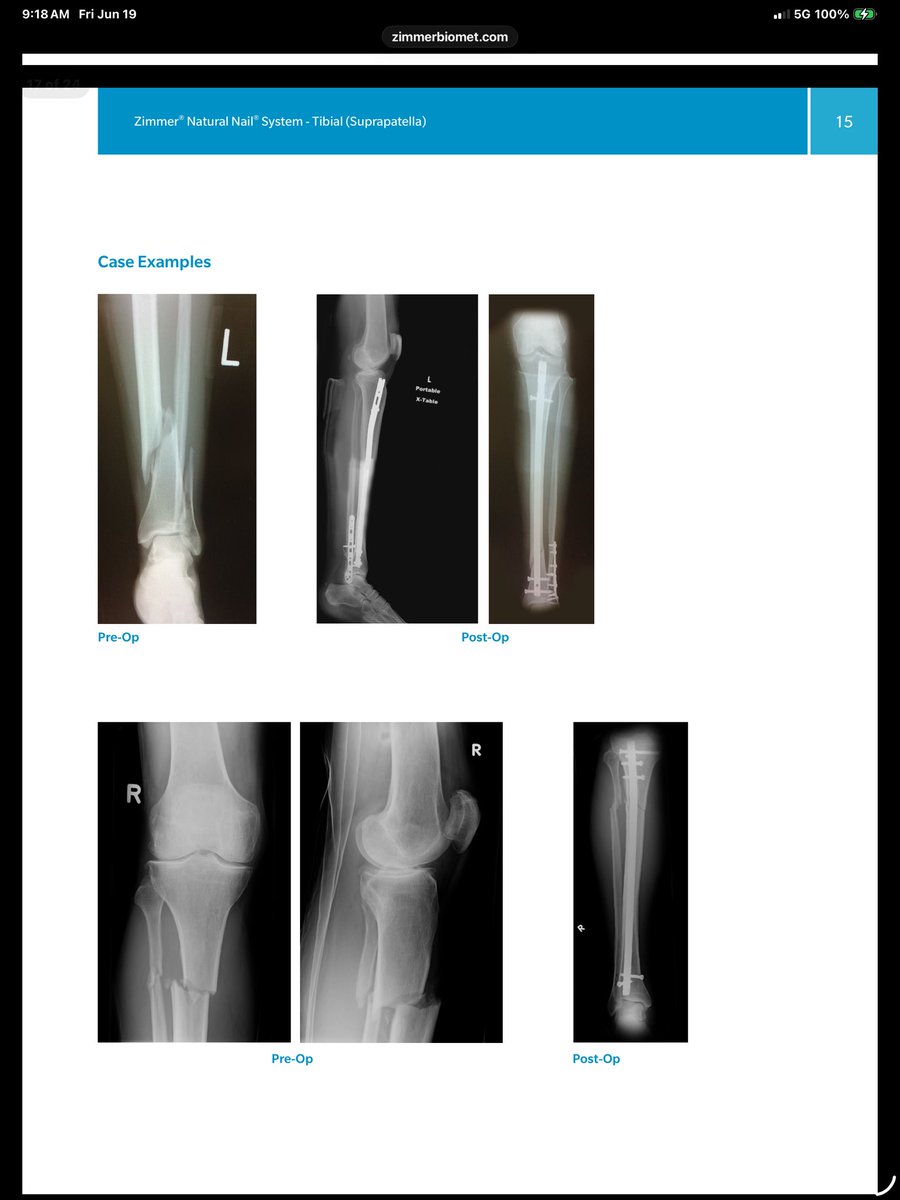 luisriosreb's tweet photo. @JewishCyclist3 @DrJesseMorse This are some examples of  the procedure. Those screws just over the ankle bother all atletes, specially in kicking and combat sports. They are removed once union is achieved. They control the bone rotation until it heals. https://t.co/5DqOdOJUo9
