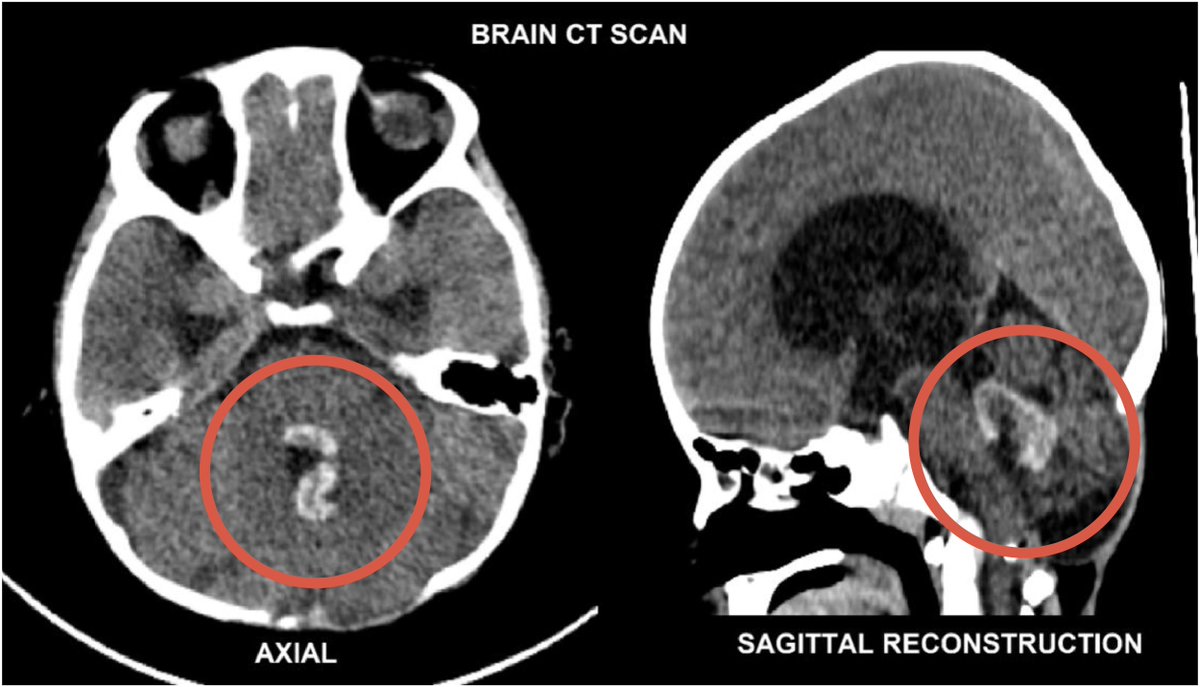 drkeithsiau's tweet photo. A 14 year old girl presented with headaches 6 months after brain tumour surgery. Her CT scan suggested possible recurrence of brain tumour, but in reality, this turned out to be surgical sponge left behind after surgery. What’s the name given to this phenomenon? https://t.co/PdS9cHSnUB