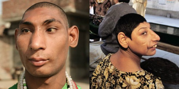 KateriSeraphina's tweet photo. Histoire vraie. Photos originales.
Quelle est la vérité la plus troublante que vous connaissiez ?
« Enfants rats du Pakistan » ou « Rats de Shah Dola ».

Devant le sanctuaire Shah Dola dans la ville pakistanaise de Gujarat, des enfants et des jeunes aux têtes déformées sont souvent vus mendiant devant le sanctuaire. Ces enfants ont la tête rapetissée, ce qui les rend difficiles à apprendre.Bien que cela puisse se produire à cause d’une maladie génétique appelée « microcéphalie », ces cas ne sont pas comme ça. Ces jeunes sont soumis à une « microcéphalie artificielle », où des fers sont placés autour de leur tête, empêchant la croissance normale du crâne et du cerveau.

On estime qu’il y a au moins 10 000 enfants rats au Pakistan, et pire encore, ils sont contrôlés par une mafia mendiante. Ils sont ensuite envoyés dans toutes les régions du pays pour mendier. La mafia mendiante les engage même sous contrat mensuel et ces enfants et adultes passent leur vie à mendier. Ils n’ont ni famille ni vie propre. En raison de leurs handicaps mentaux, ils dépendent des autres.

Tout cela fonctionne encore parce que l’homme ordinaire ne refuse jamais de donner de l’argent aux rats de Shah Dola, on croit fermement que si vous refusez, vos enfants deviendront handicapés. Ainsi, pour la mafia mendiante, ces pauvres âmes sont une garantie de revenus réguliers.
Source: https://t.co/NtAAXT5rsV