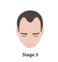 toensures's tweet photo. the saddest part about balding is that noone ever stays at this point https://t.co/Z7GccJYj6X
