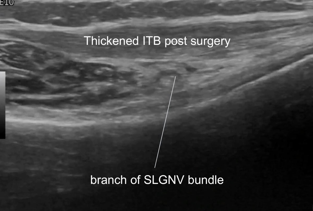 DrJN_SportsMed's tweet photo. Consent ✅ - including facial recognition

I have wondered for some time whether a subset  of stubborn 'ITB syndrome' cases are actually cases where a distal recurrent branch of the superolateral genicular neurovascular bundle is being compressed under the ITB

This has not been described before

In this case, the patient had bilateral lateral knee pain, which didn't respond to conservative measures, and so underwent partial ITB release - this made him worse

His symptoms now simply on sitting and walking - not just classic downhill running and cycling 

Pain is felt diffusely above and below lateral joint line

Previous diagnostic injection around the potential culprit SLGN branch (sat deep to a thickened ITB post surgery in heavy scar tissue) abolished his pain on the treadmill post procedure - but unfortunately no lasting therapeutic effect

So I agreed to step outside of my comfort zone and do something completely novel - radiofrequency ablation (RFA) of this specific nerve bundle under US guidance placement with the help of my pain specialist consultant colleague (see video reel)

NOTE - this is not the well described  pain specialist SLGN target up stream at the deep lateral femoral periosteal border (growth plate level) which is often done under fluoroscopic guidance eg for advanced OA knee in patients unsuitable for arthroplasty 

During the trochar placement and RF current being applied to the bundle, the patient reported that is was his typical pain

We shall see how his symptoms improve (with the untreated contralateral side as a reference point) over the next few weeks