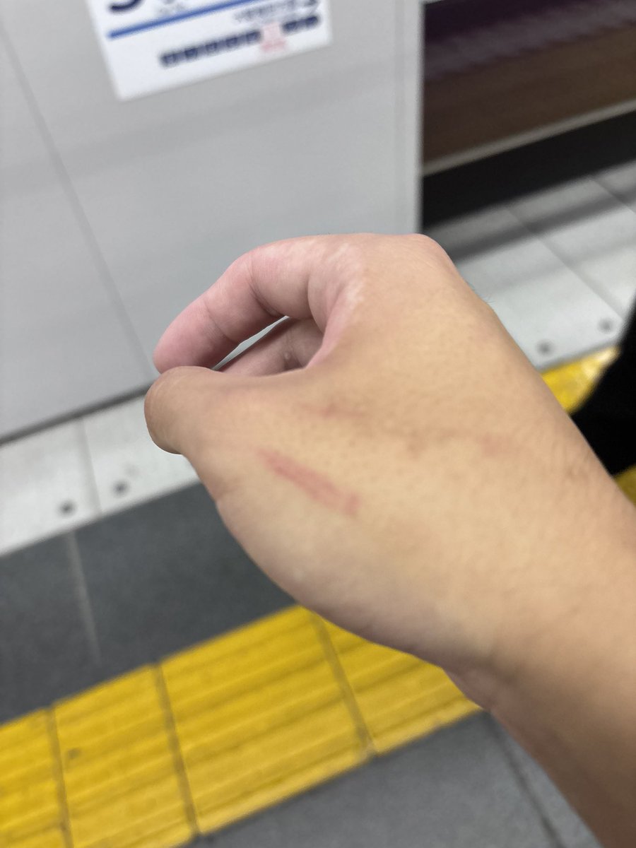 noa_ammo's tweet photo. 2日連続ドライヤーせずに寝落ちしたせいで鼻やられて喉はカラオケいってから多分やられてて風邪みたいな状態で営業してたら火傷した最悪。
社員さんがカコナール買ってくれたし終電やからって先帰らせてくれて残って締め作業してもらってる。ほんとに感謝してますいつも。 https://t.co/XwIMEGinpS