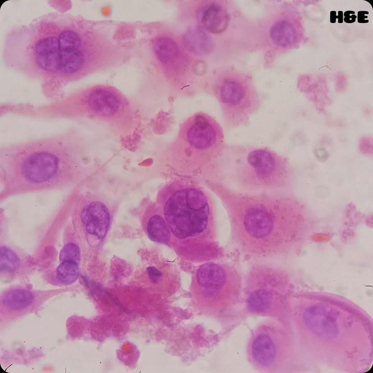 duckhuca's tweet photo. 👉🏽 Thyroid nodule.  📏 22mm. 🪨 Macrocalcifications.
💉 Ultrasound guided fine needle aspiration performed by Interventional Pathologist.
1️⃣ Pass.
2️⃣5️⃣ g.
🔬 Bethesda VI.  Papillary Thyroid Carcinoma.
#CytoPath #FNAFriday #Cytology https://t.co/azCokHpfxy