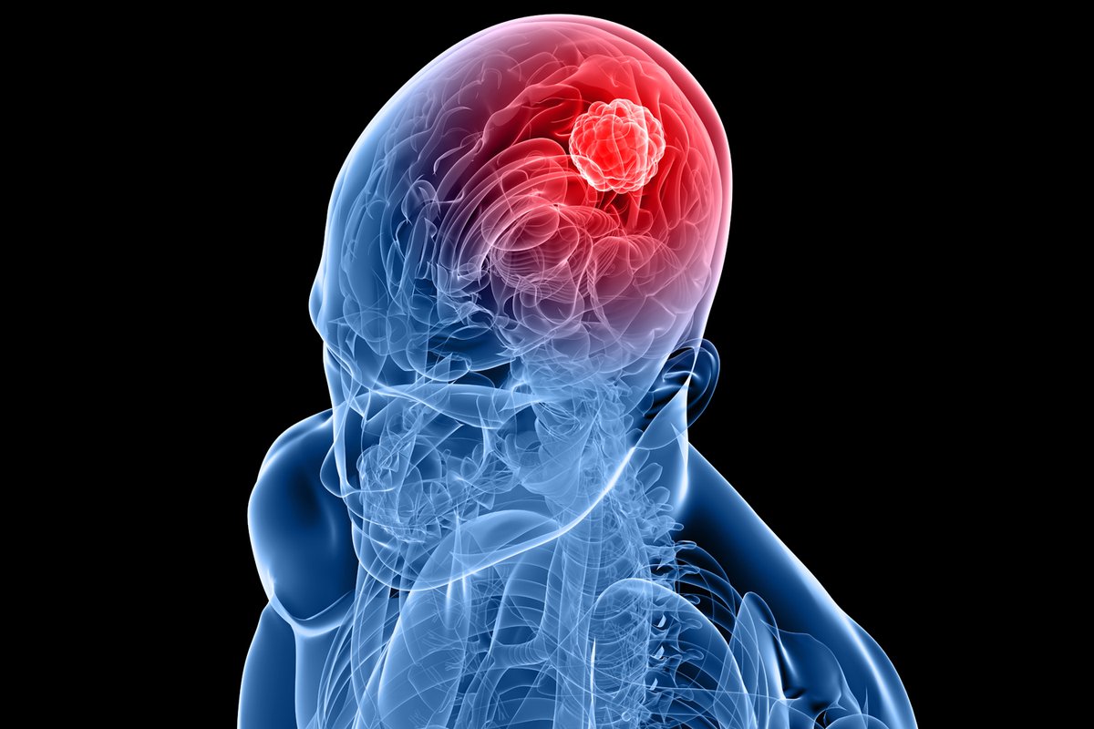 NightSkyToday's tweet photo. JUST IN🚨: Malaysian doctors used sound waves alone to destroy Brain Tumors without a single incision. https://t.co/2aHdNDQpQT