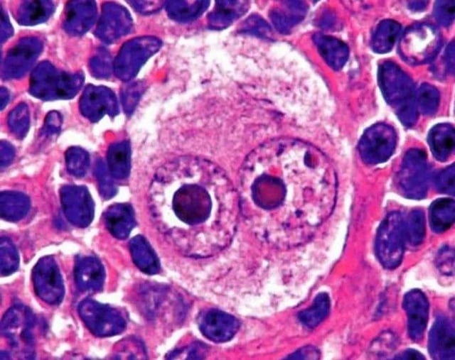 Chiragrx07's tweet photo. Which Virus Infection Shows this Histology Findings?? https://t.co/jvHT1NuV1E