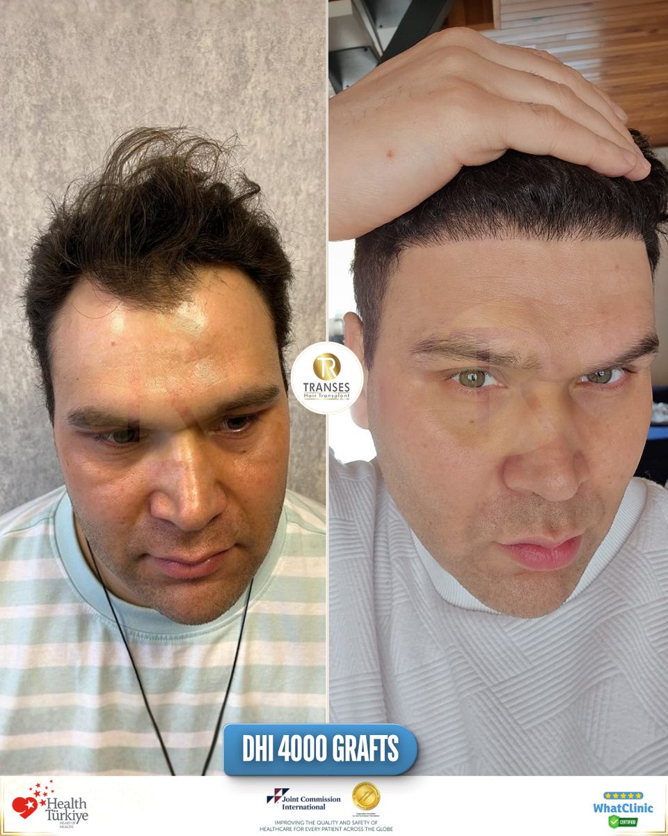 transeshair's tweet photo. This hair transplant operation was performed at Istanbul Tema Hospital BHT Clinic.
15 years of experience with a 4.9 ⭐ WhatClinic rating.
FUE • DHI • HYBRID • PRP
Natural results, professional care.

#YourJourneyYourTransformation
#TransesHairTransplant
#FUE #DHI #PRP https://t.co/mg562AMGBR