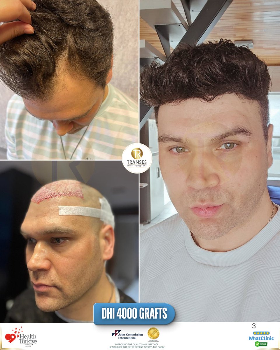 transeshair's tweet photo. This hair transplant operation was performed at Istanbul Tema Hospital BHT Clinic.
15 years of experience with a 4.9 ⭐ WhatClinic rating.
FUE • DHI • HYBRID • PRP
Natural results, professional care.

#YourJourneyYourTransformation
#TransesHairTransplant
#FUE #DHI #PRP https://t.co/mg562AMGBR