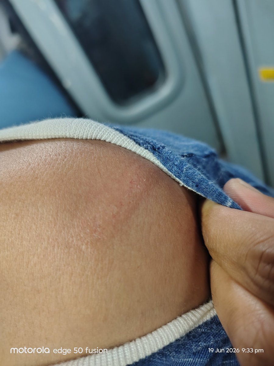 Amar4Change's tweet photo. @RailMadad @RailMinIndia @RailwaySeva I got hit by this seat, while opening the door it fell on my shoulder and face, nothing major happened but got bruises and scratches lucky to survive major injury. Can you take appropriate action to fix this. 
Trn:16583 YPR to BIDR https://t.co/fxuOlQxJVu