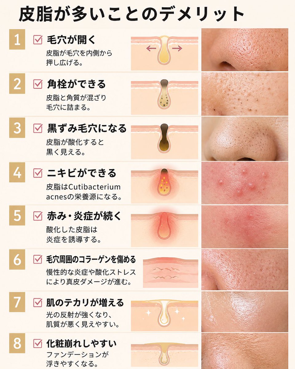 imaikazuomi_dr's tweet photo. 【皮脂が多いことのデメリット】

皮脂を抑えることが肌にとっての最強のアンチエイジングになります。

✅ 毛穴が開く
皮脂が毛穴を内側から押し広げる。

✅ 角栓ができる
皮脂と角質が混ざり毛穴に詰まる。

✅ 黒ずみ毛穴になる
皮脂が酸化すると黒く見える。

✅ ニキビができる
皮脂はアクネ菌の栄養源になる。

✅ 赤み・炎症が続く
酸化した皮脂は炎症を誘導する。

✅ 毛穴周囲のコラーゲンを傷める
慢性的な炎症や酸化ストレスにより真皮ダメージが進む。

✅ 肌のテカリが増える
光の反射が強くなり、肌質が悪く見えやすい。

✅ 化粧崩れしやすい
ファンデーションが浮きやすくなる。