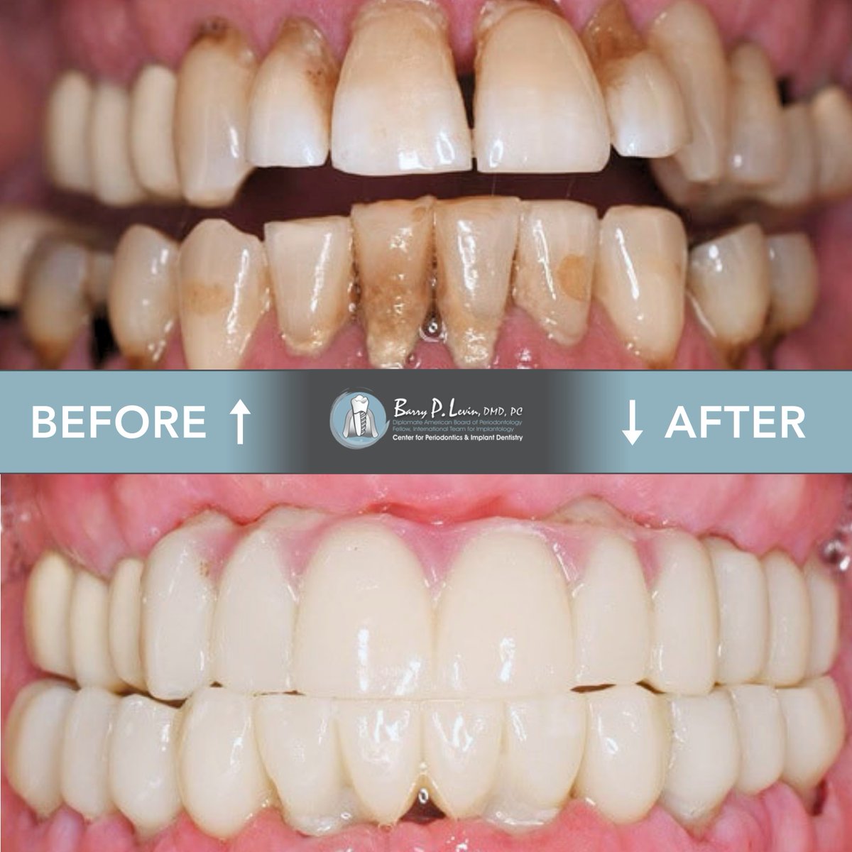 Aperio_Doc's tweet photo. ✨ We’re more than just a dental office—we’re your smile partners. Visit Barry Levin near Levittown and see why families across Bucks County &amp; surrounding areas trust us to care for their smiles.

Check out more before &amp; afters here: https://t.co/hBgNi9LSew https://t.co/LAiuc77uF6