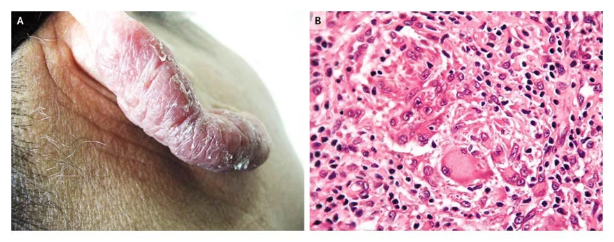 guerreroespejo's tweet photo. 52-YO ♀️ from Tunisia: a 2-year history of an asymptomatic, thick, reddish infiltrated plaque on her right ear (A) 

🔬: epithelioid granulomas suggestive of leishmaniasis, tuberculosis, or sarcoidosis (B)
½

DOI: 10.1056/NEJMicm0708175
#dermatology #MedEd #IDMedEd https://t.co/M5phzBwLq1