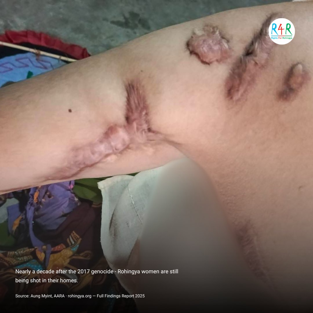 ROHRIngya's tweet photo. Tomorrow is World Refugee Day.

Tonight Arofa Begum will sleep in a refugee camp. Shot six times. Everyone gone except her daughter.

She doesn't need a hashtag. She needs to go home.

What does World Refugee Day actually change? →

#WorldRefugeeDay #Rohingya #RefugeeDay2026 https://t.co/BD6xirgx48