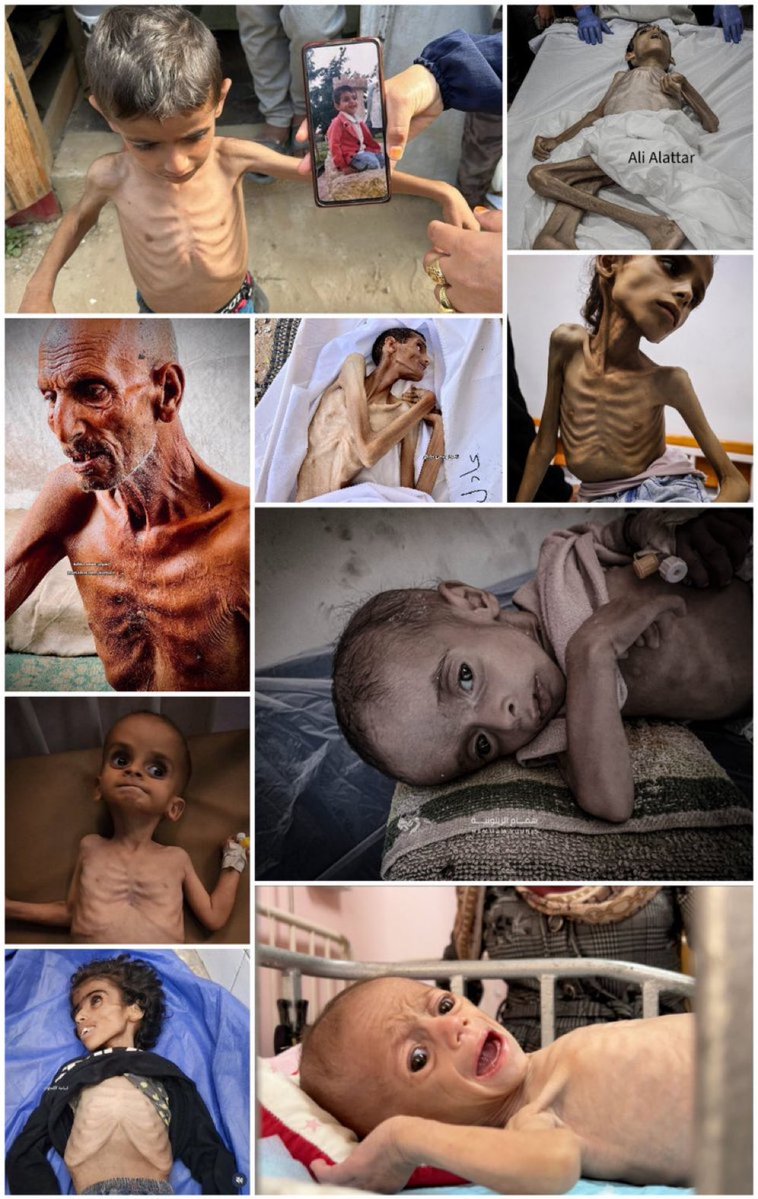 RamAbdu's tweet photo. This is how innocent people in Gaza collapsed from hunger before the eyes and ears of the world, as the genocide unfolded. https://t.co/h9gJLuQ2Mh