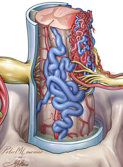 mtlawton's tweet photo. Watch this #SevenSeries video showing this C4-7 laminectomy, transpedicular approach, resection of eccentric extra-/intramedullary spinal cord arteriovenous malformation (Type 5), on our website @BarrowNeuro by clicking on this link… https://t.co/J7JSfScET4. https://t.co/A7oqhXyMOr