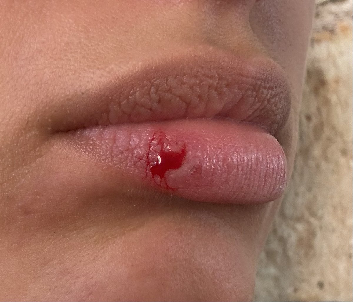 kat4morant's tweet photo. litoll compilation of times ive made my lips bleed this might come off as attention seeking (sadly true() but sometimes i just can’t stop i literally have done this like 4 times at work nd my friend my mom has told me to stop bruh https://t.co/1ZstRdDfqY