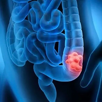 NightSkyToday's tweet photo. 🚨: Korean scientists have developed a technique that reverts colon cancer cells back into normal cells while also not damaging healthy tissue like usual treatments do.

Further clinical trials are required before being tested on human patients. https://t.co/GZ8p6dOA94